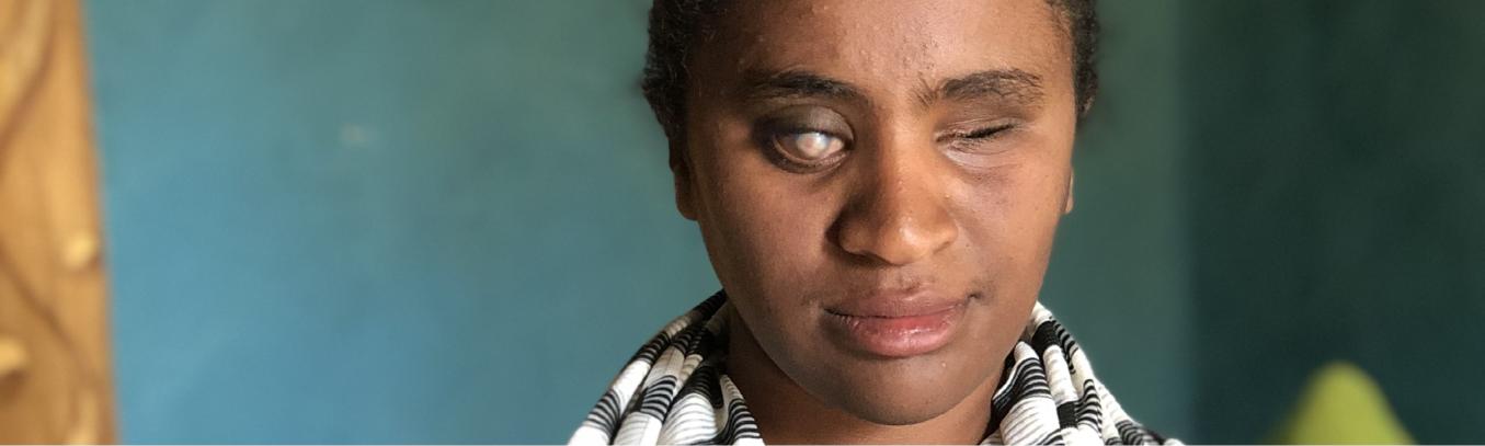 Tummaihoinen henkilö mustavalkoinen huivi kaulassaan, toinen silmä on umpeutunut ja toinen lasisen näköinen, siis sokea.